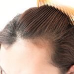 Hair Loss Treatment