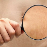 Stretch Marks1