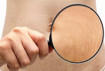 Stretch Marks1