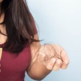 Hair Loss in Women3